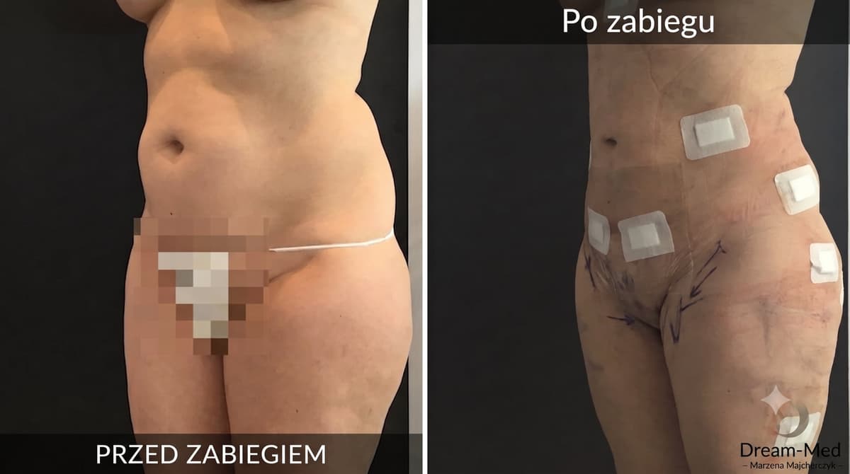 Chirurgia estetyczna powiek w Dream-Med – odmłodzenie spojrzenia