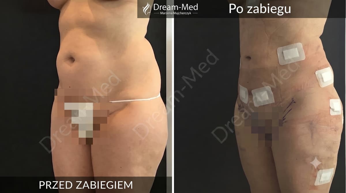 Dream-Med: Liposukcja – Odzyskaj Sylwetkę Marzeń w Łodzi