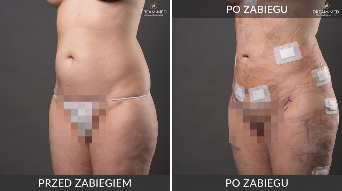 Toksyna botulinowa Łódź: Przewodnik po zabiegach w Dream-Med